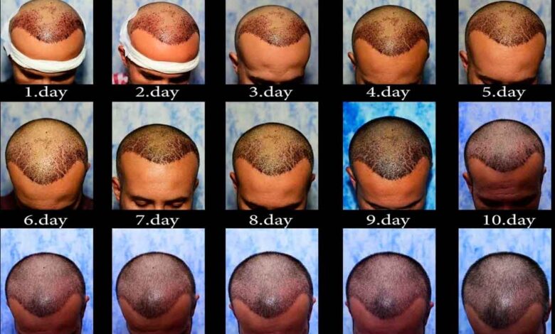 Turkey Hair Transplant - Day by Day